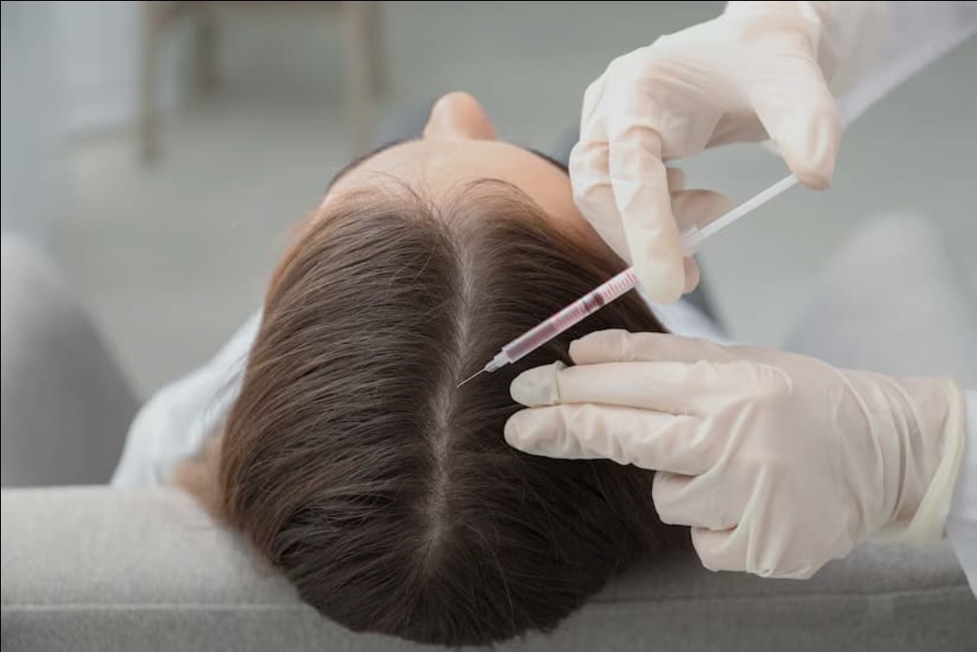 Mesoterapia Capilar