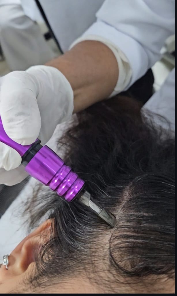 MMP — Microinfusão de Medicamentos pela Pele
